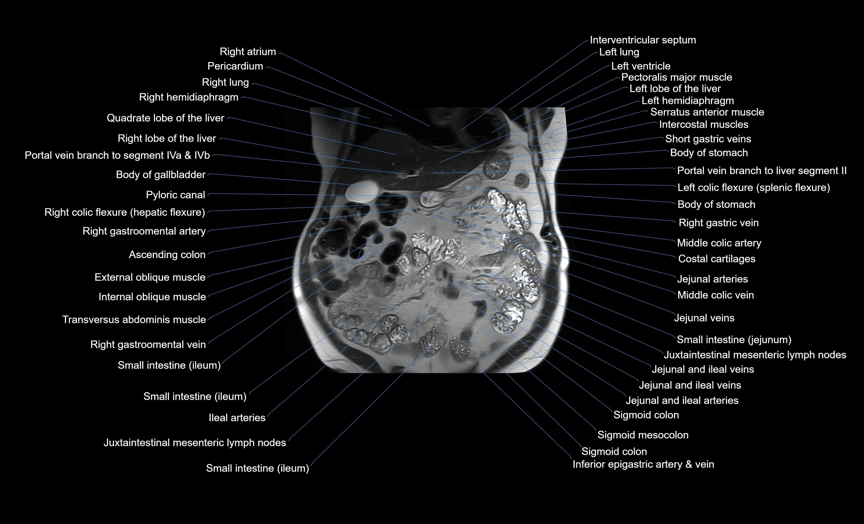 MRI Abdomen coronal labelled cross sectional anatomy radiology  image-img-00001-00020.webp